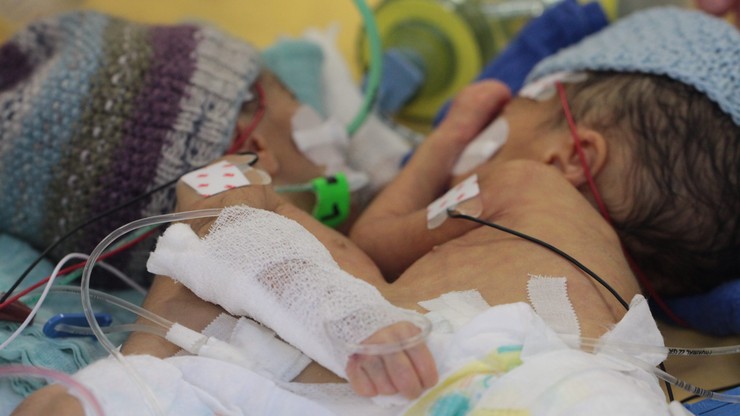 Najmłodsze bliźniaki syjamskie rozdzielono w Szwajcarii