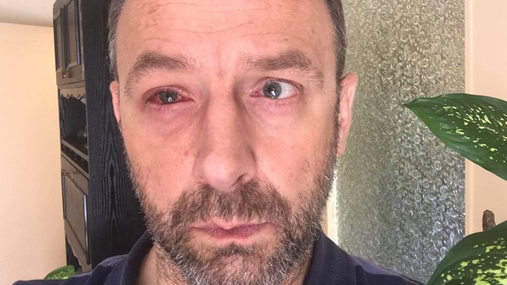"Prawe oko nie nadaje się do niczego". Burmistrz Krosna o stanie zdrowia po nieudanym żarcie strażaków