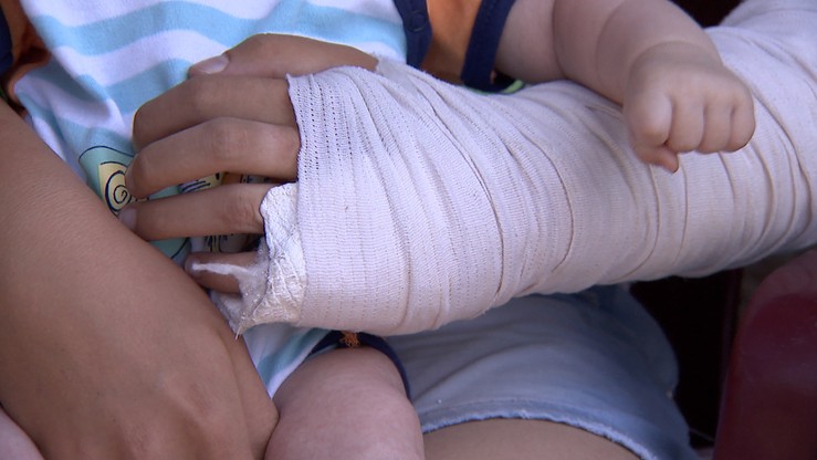 Pies dotkliwie pogryzł dzieci. Złamana ręka, poszarpany mięsień uda